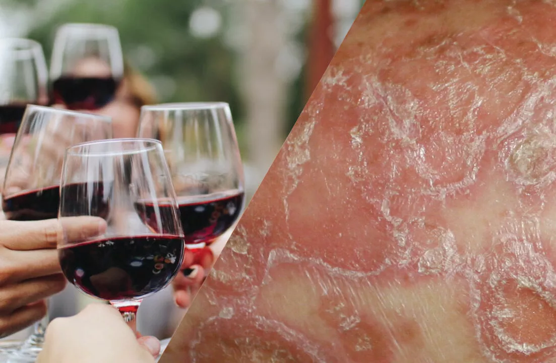 Plaque Psoriasis and Alcohol: What You Need to Know
