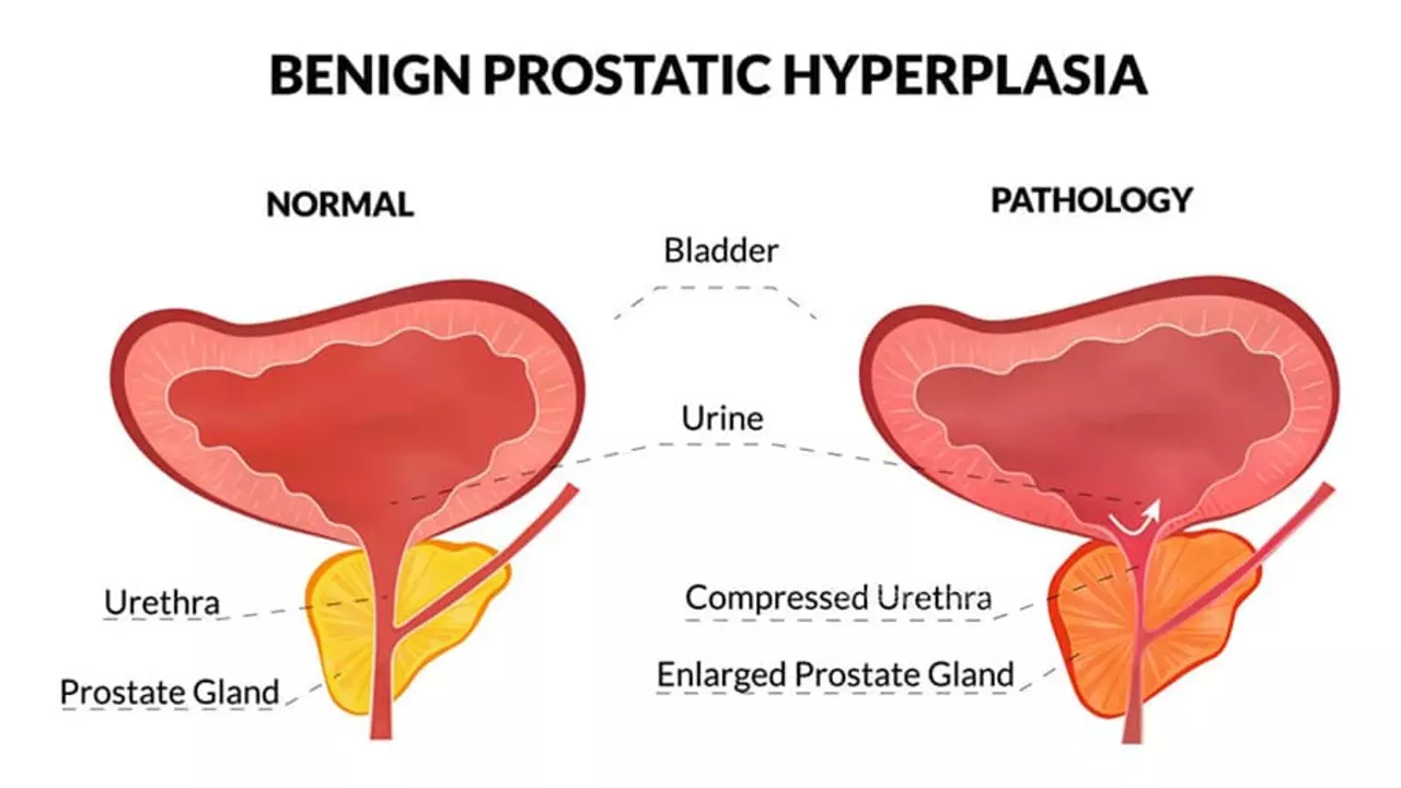 The Connection Between Enlarged Prostate and Bladder Stones